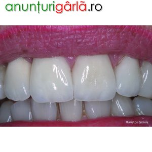 Imagine anunţ Zirconiu dentar