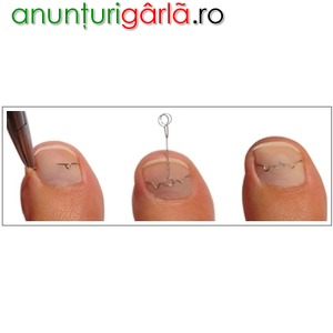 Imagine anunţ 3TO Spange - Tratare unghii incarnate