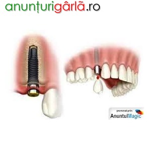 Imagine anunţ Implant dentar pret avantajos Bucuresti