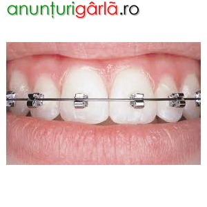 Imagine anunţ Aparate ortodontice stomatologie Bucuresti